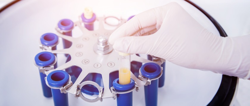 Bioestimulación capilar con plasma rico en plaquetas.